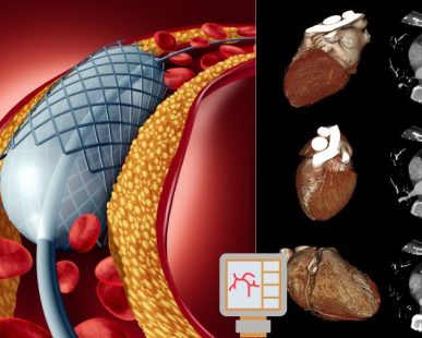 Difference Between Angioplasty, Angiography, and Angiogram