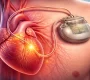 heart pacemaker treatment in Delhi 90x80